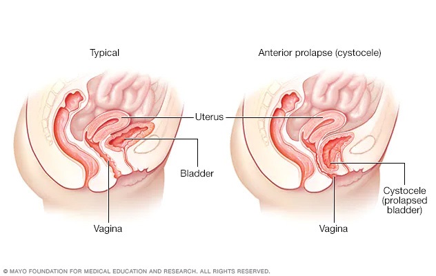 Prolapso vaginal anterior (cistocele)