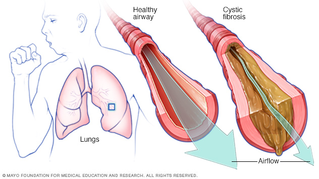 Fibrosis quística