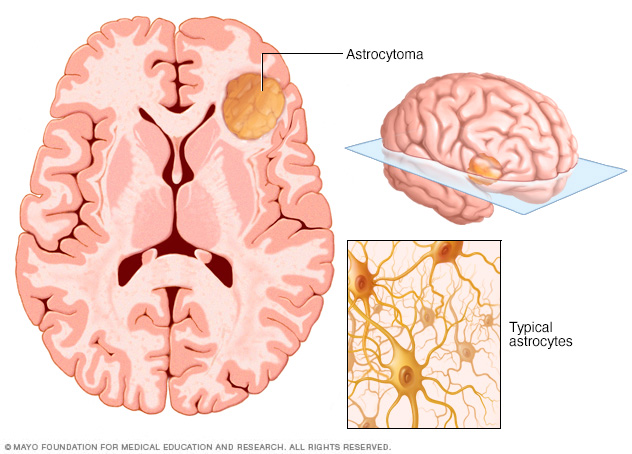 Astrocytoma