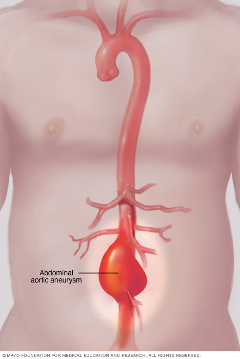 Aneurisma de la aorta abdominal