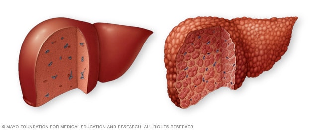 Cirrosis
