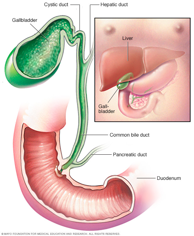 Colangiocarcinoma (cáncer de las vías biliares)