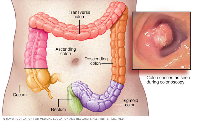 Colon cancer
