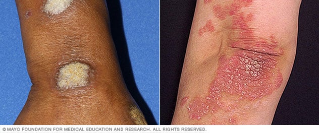 Artritis psoriásica