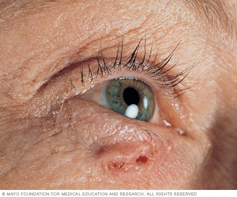 Basal cell carcinoma