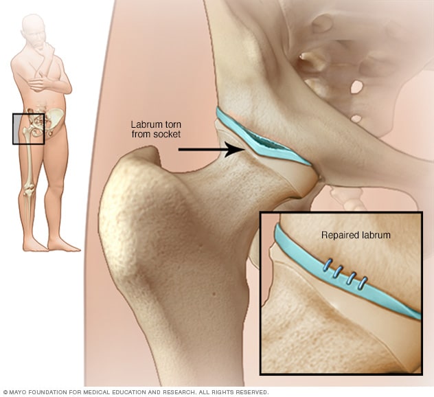 Hip labral tear