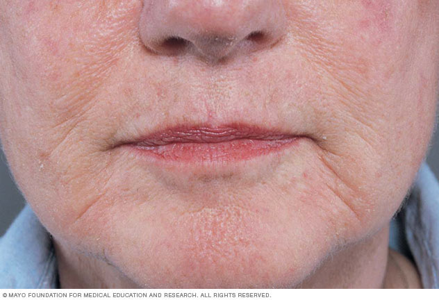 Wrinkles