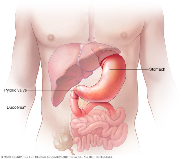 Gastritis