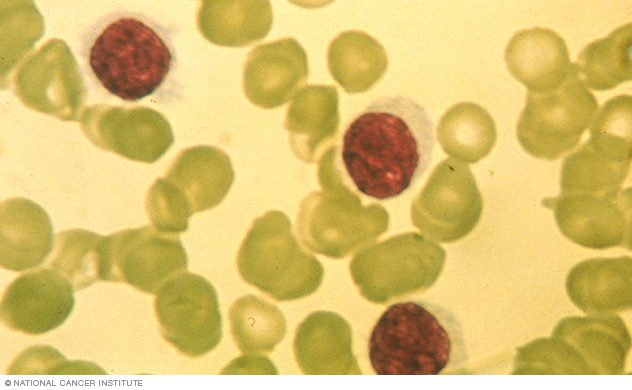 Leucemia de células peludas