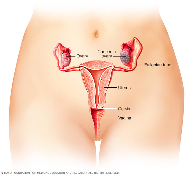 Cáncer de ovario