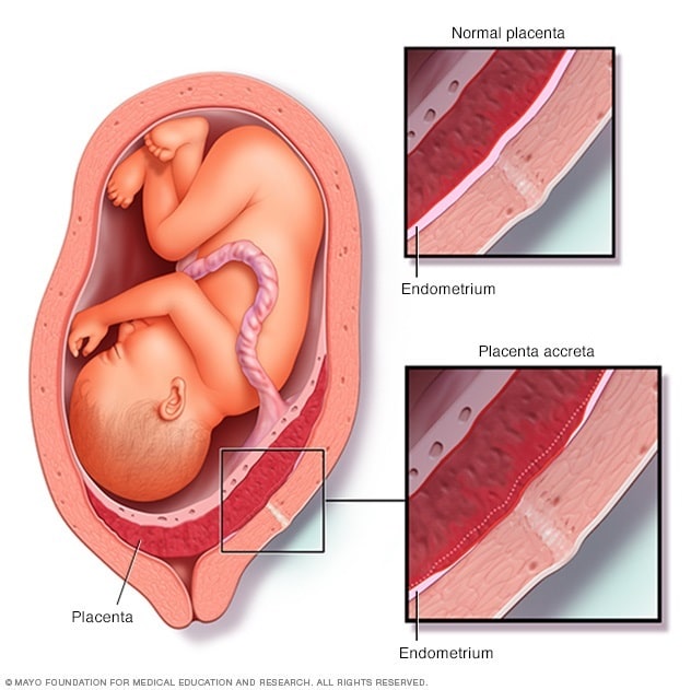 Placenta accreta