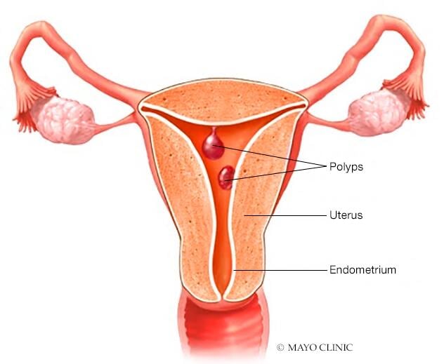 Pólipos uterinos