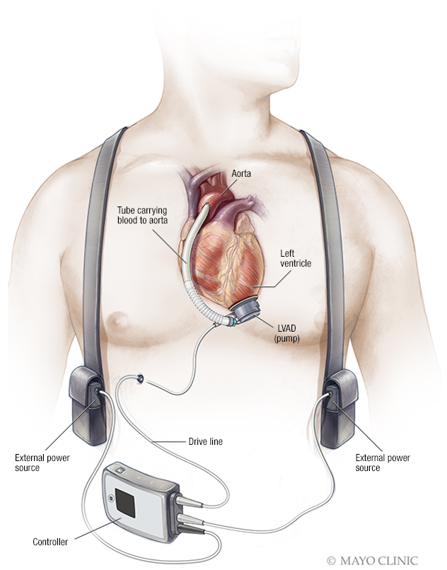 Dispositivo de asistencia ventricular (VAD)