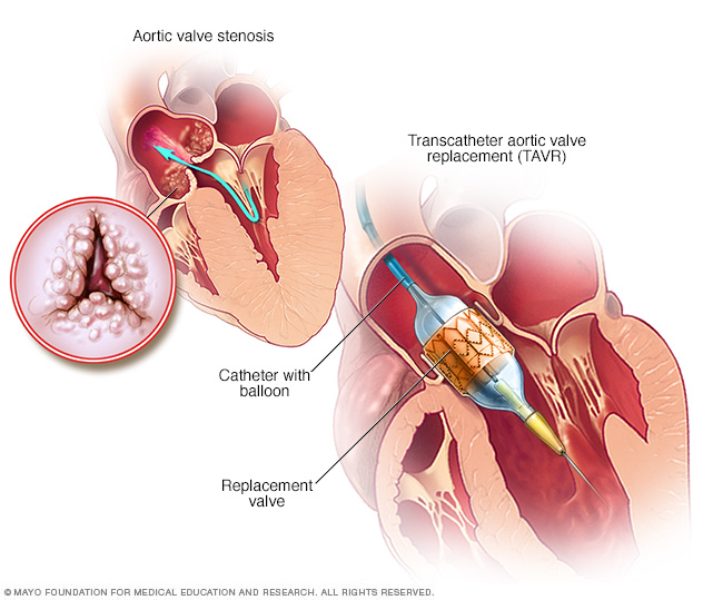 Transcatheter aortic valve replacement (TAVR)