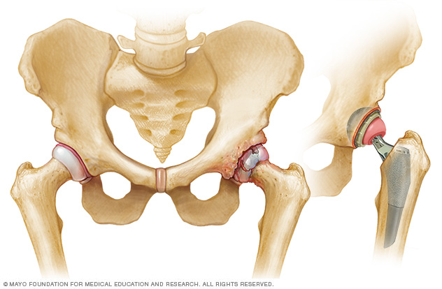 Hip replacement