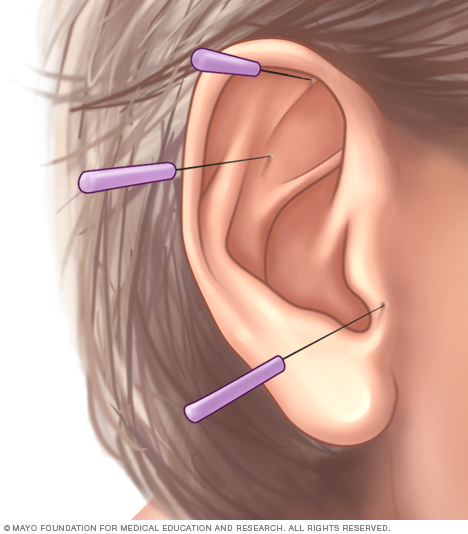 Acupuntura