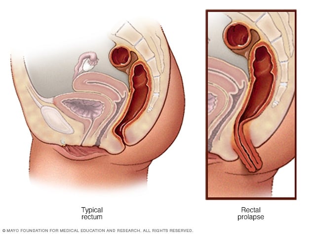 Cirugía de prolapso rectal