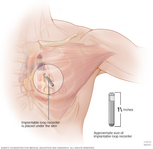 Registrador de bucle implantable: un dispositivo de monitorización cardíaca