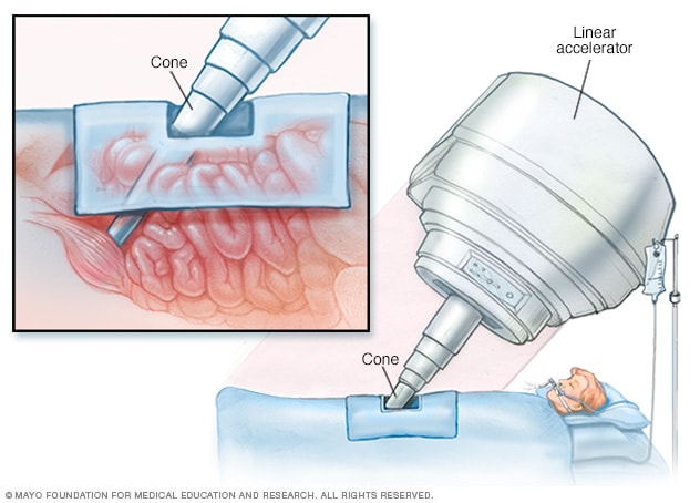 Radioterapia intraoperatoria (IORT)
