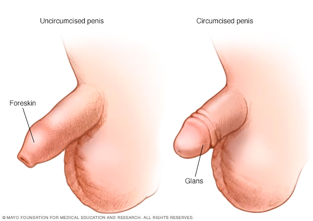 Circuncisión (masculina)