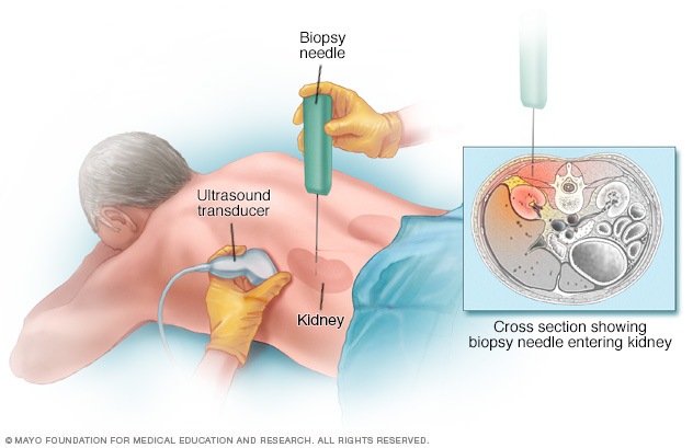 Biopsia renal