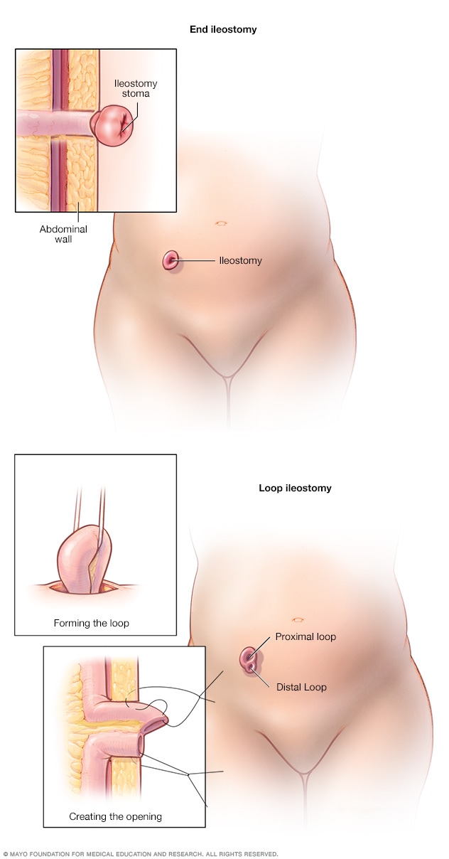 Ileostomía